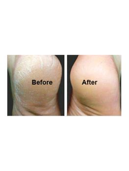 Ureka 25% Urea Footcare Cream 50ml (Heels Before and After)